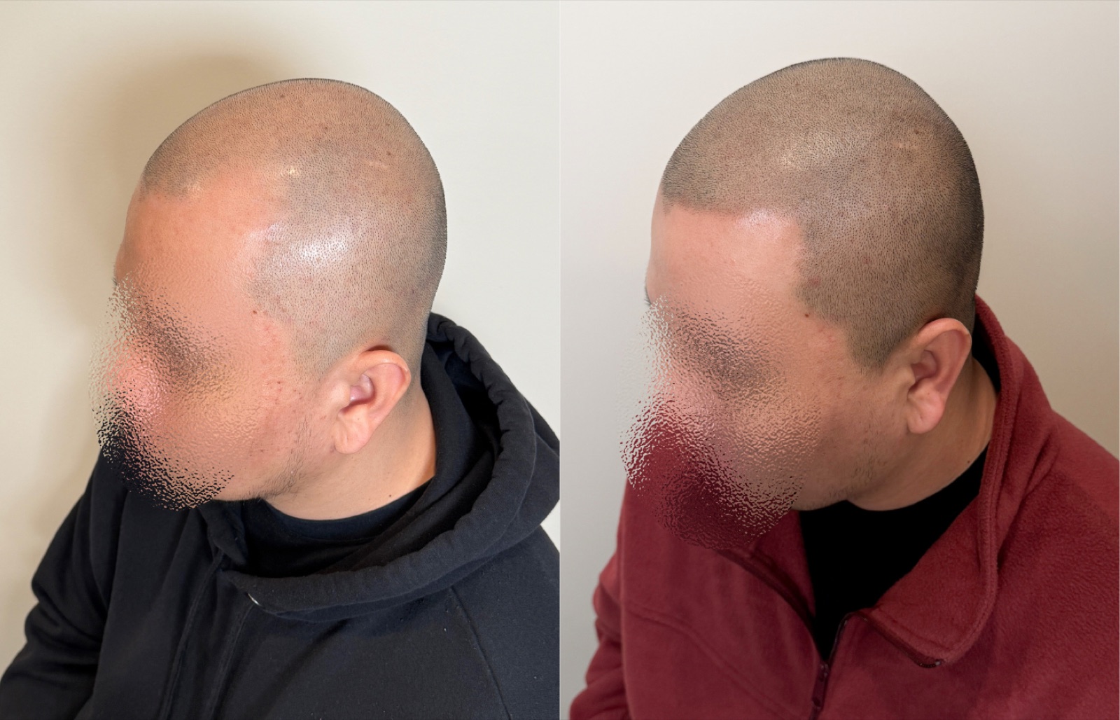 Shaved look SMP portfolio 25